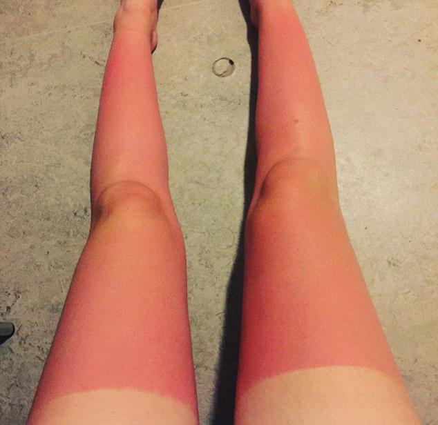 These tell-tale tanning lines are all too familiar for those who love to lie in the sun in short shorts