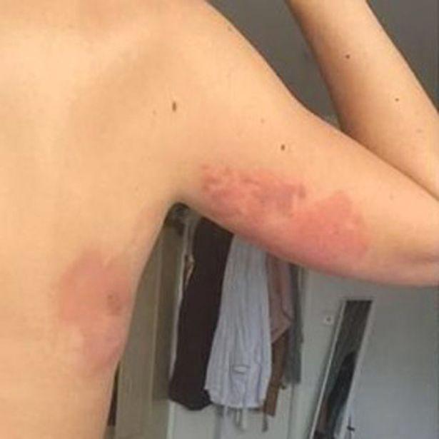  She may be scarred for life after the liquid melted her clothes into her skin