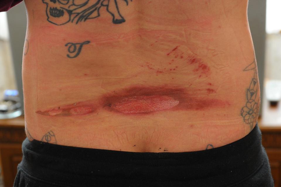  Ian Cudbertston was left with horror acid burns on his back after his e-cigarette exploded