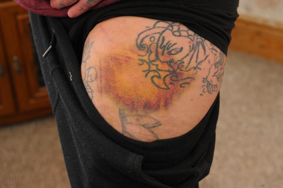  A bruise the size of his fist was caused by debris from the blast striking Ian's leg