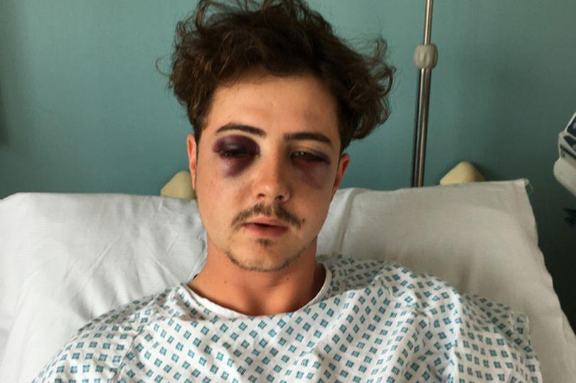  Docs fear Michael, 23, could have permanent damage to his eyesight after the unprovoked attack outside Wembley Stadium