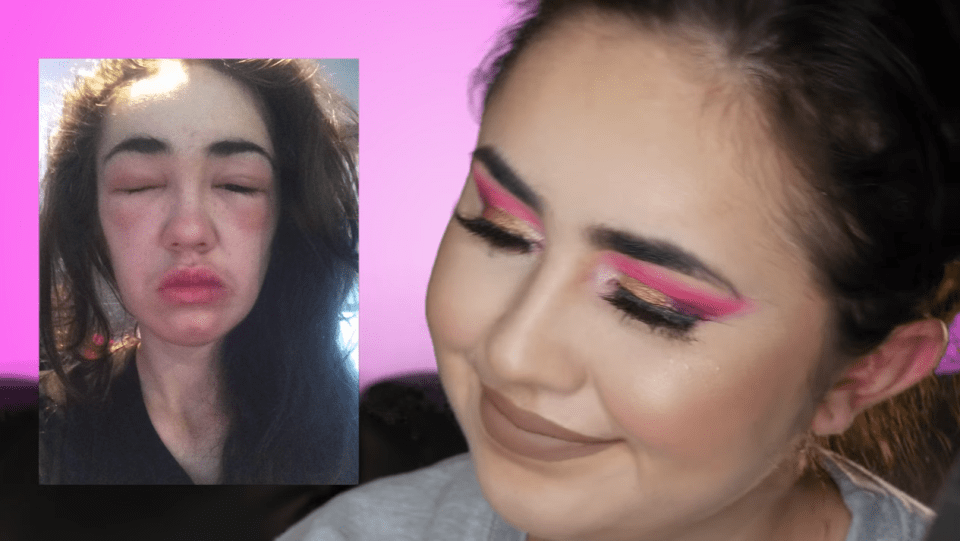  The vlogger claimed she had a horrific allergic reaction to the makeup remover