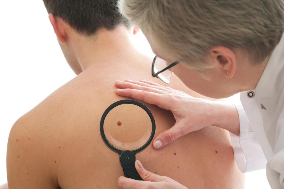  Skin cancer has a 90 per cent survival rate if it's caught early