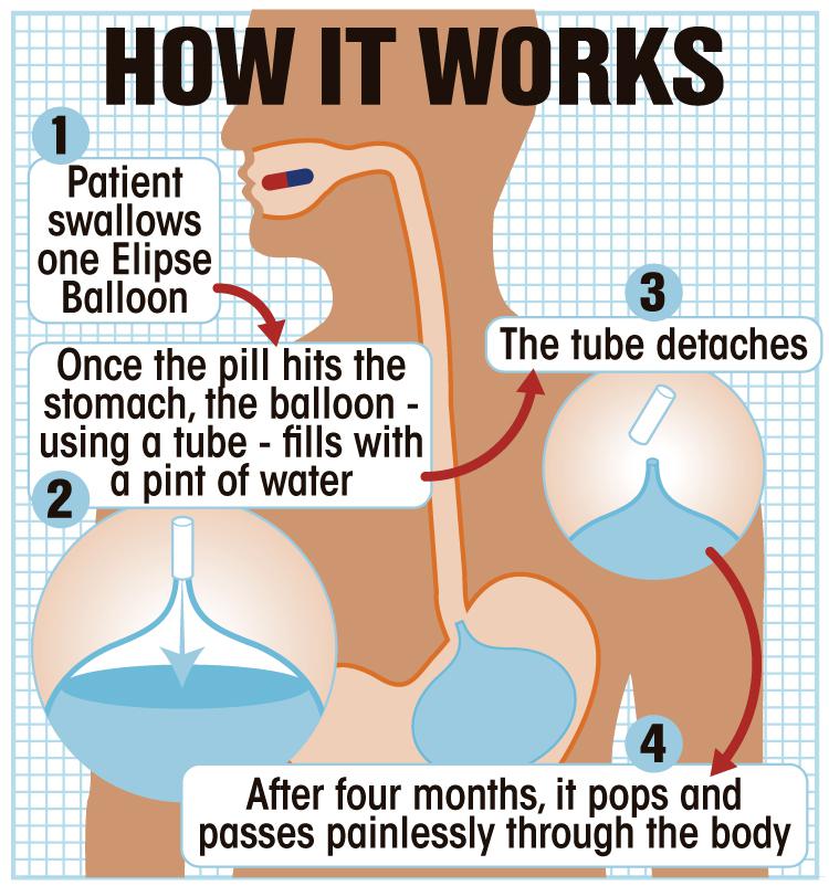  Unlike a gastric band, the Elipse pill does not require risky surgery.