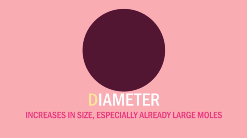  Any increases in size, especially in moles which are already large could be seen an indication of cancer