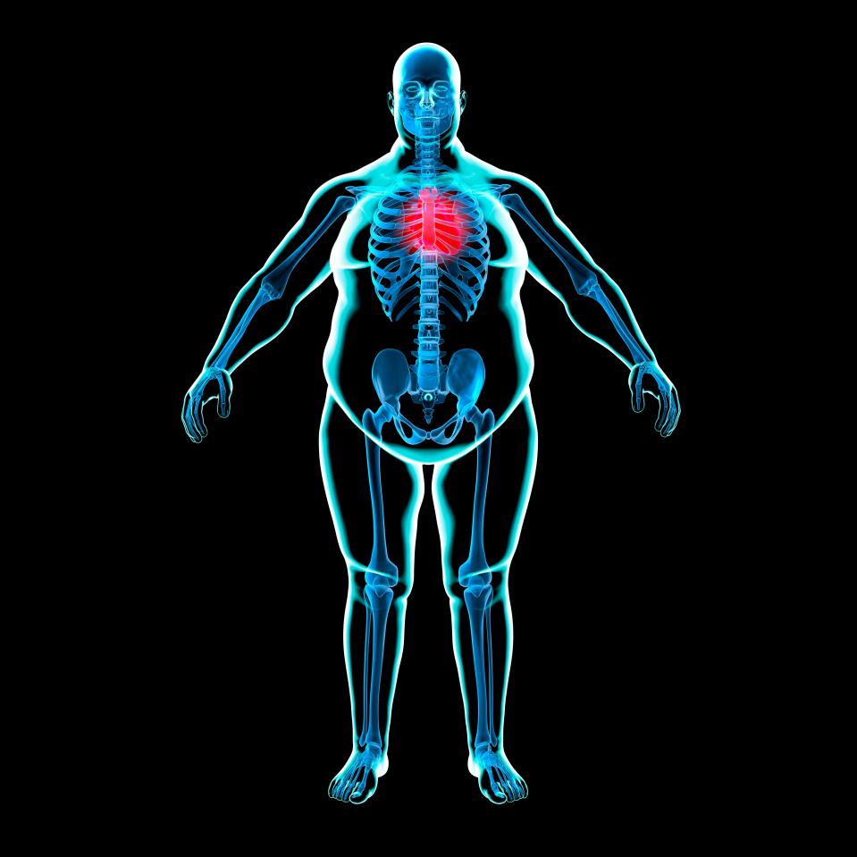  Despite having normal cholesterol and blood pressure readings, people who are fat are still at greater risk of heart attack and stroke, experts warned