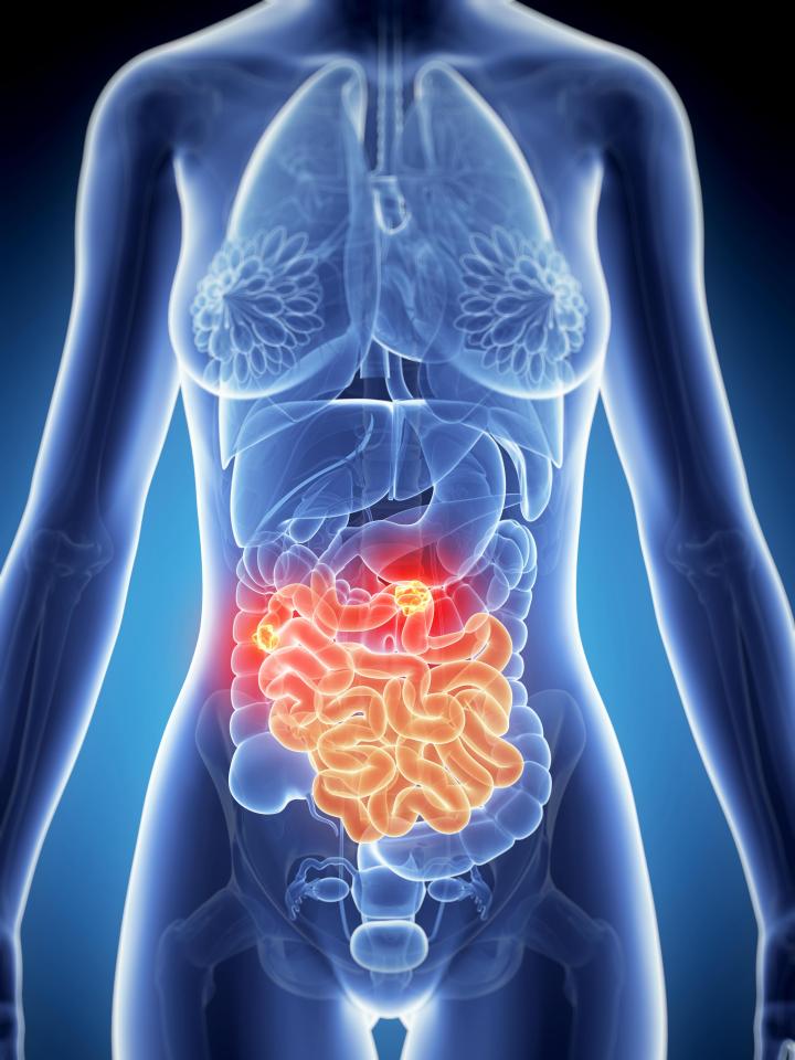  The signs and symptoms of IBS can be very similar to other, more serious diseases including bowel cancer. While in most cases it won't be serious, it is important to see your GP