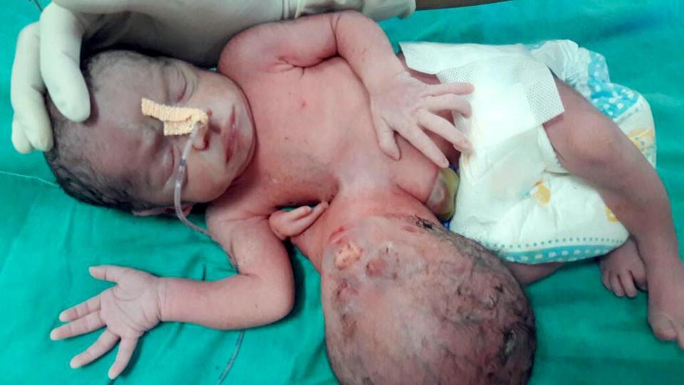  The parents were told they were carrying twins during a routine ultrasound but it was not picked up that one of the twins was parasitic