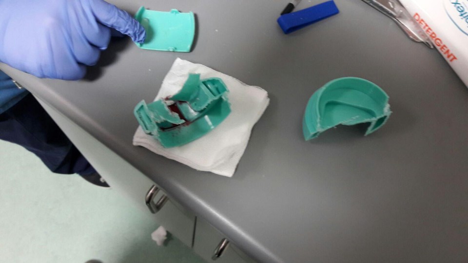 Hospital staff were forced to use a hacksaw and drill to remove the cup after it got stuck