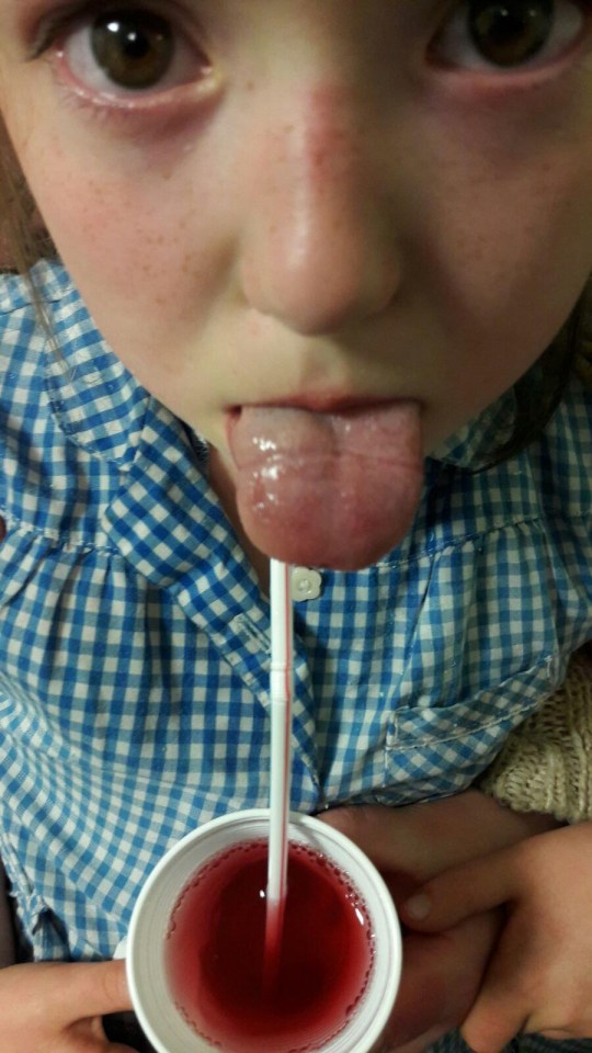 The seven-year-old girl got the lid stuck halfway up her tongue