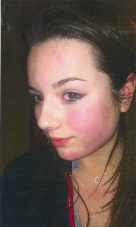 This image shows Emily’s swollen face after a vicious assault