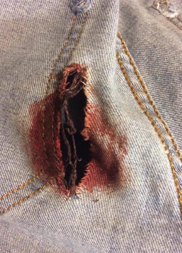  Pieces of shrapnel from the suicide bomb tore through one girl's jeans and into her leg