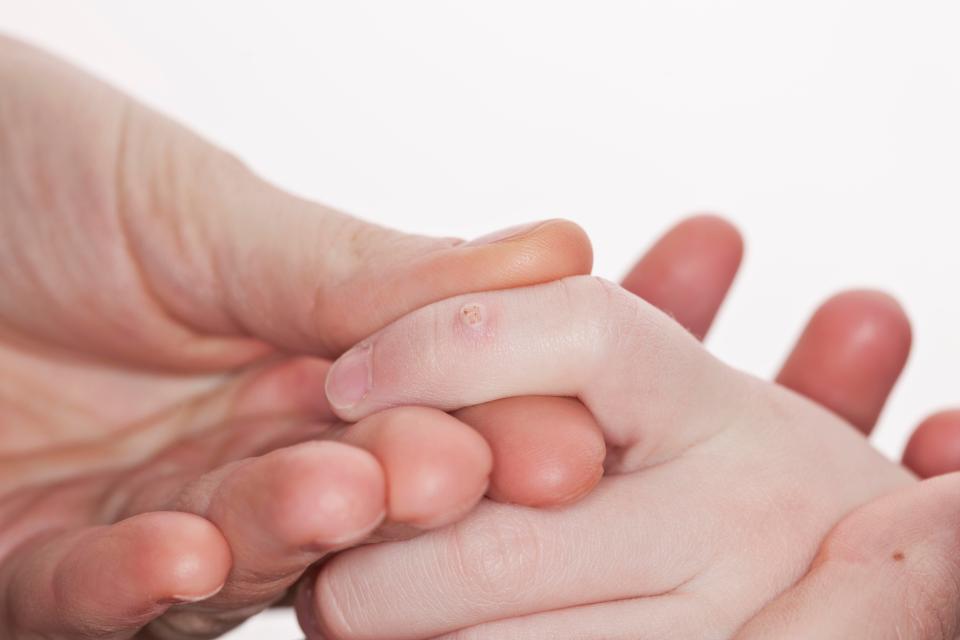  Warts are lumps that appear commonly on the skin, while verrucas are a type of wart that affect the feet