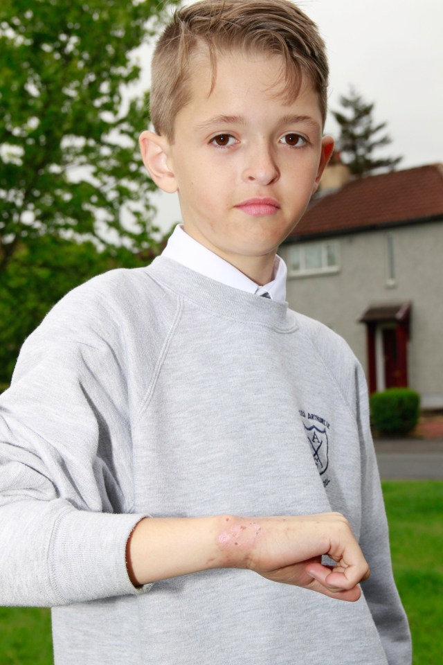 Little Adam, 11, was rushed to hospital by his mum after his skin broke out in agonising blisters