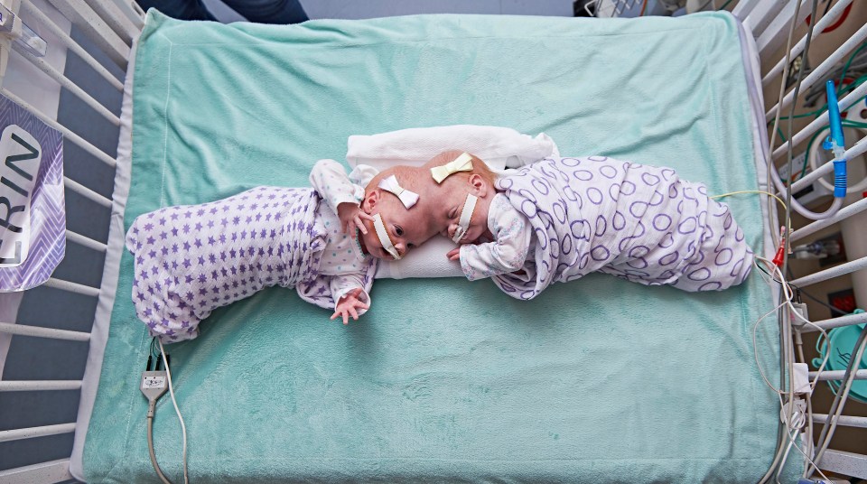 Conjoined twins Abby and Erin Delaney have been separated successfully during an 11-hour operation