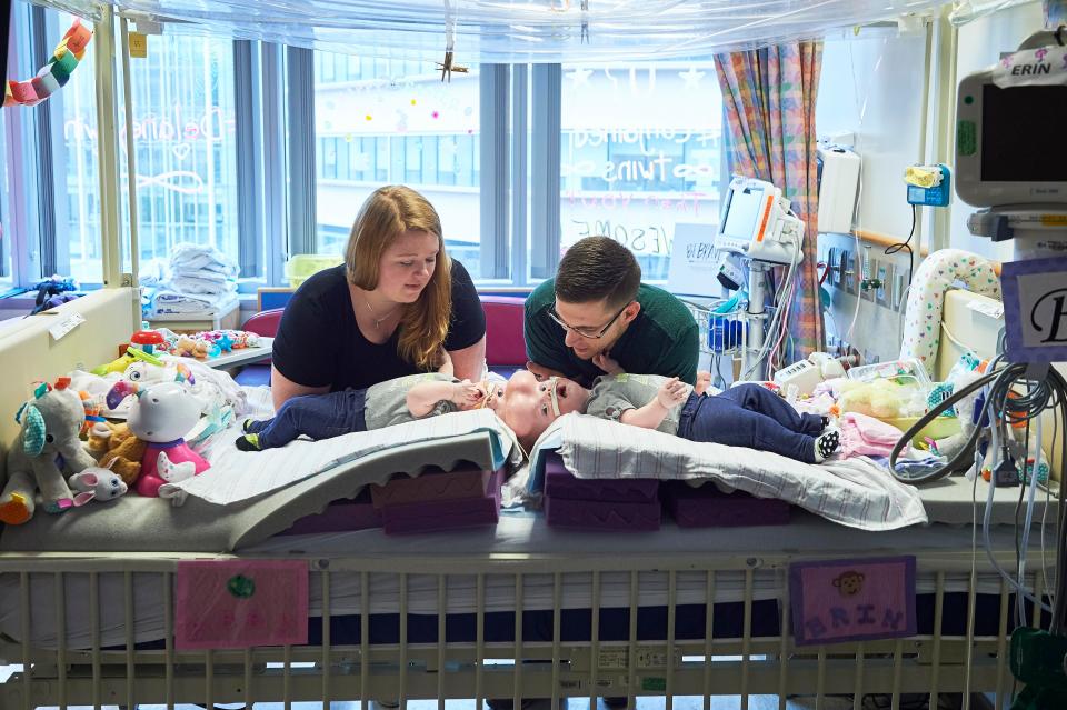 The girls were joined at the top of their heads - the rarest form of conjoined twins - and shared key blood vessels and a protective membrane around their brains