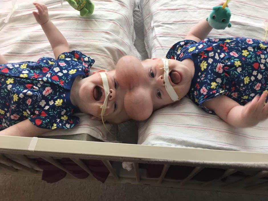 The girls were joined at the top of their heads, the rarest form of conjoined twins