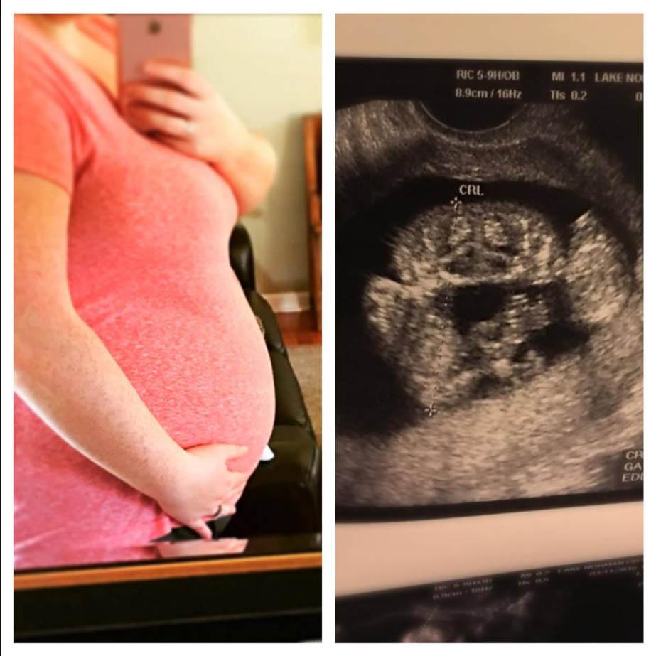 Scans revealed the girls were joined at the head and at 19 weeks Heather began fortnightly hospital visits to track their progress