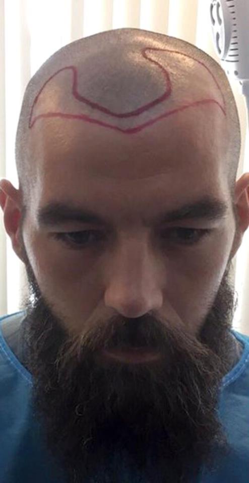  Joe Ledley had his head scribbled with marker pen ahead of his treatment