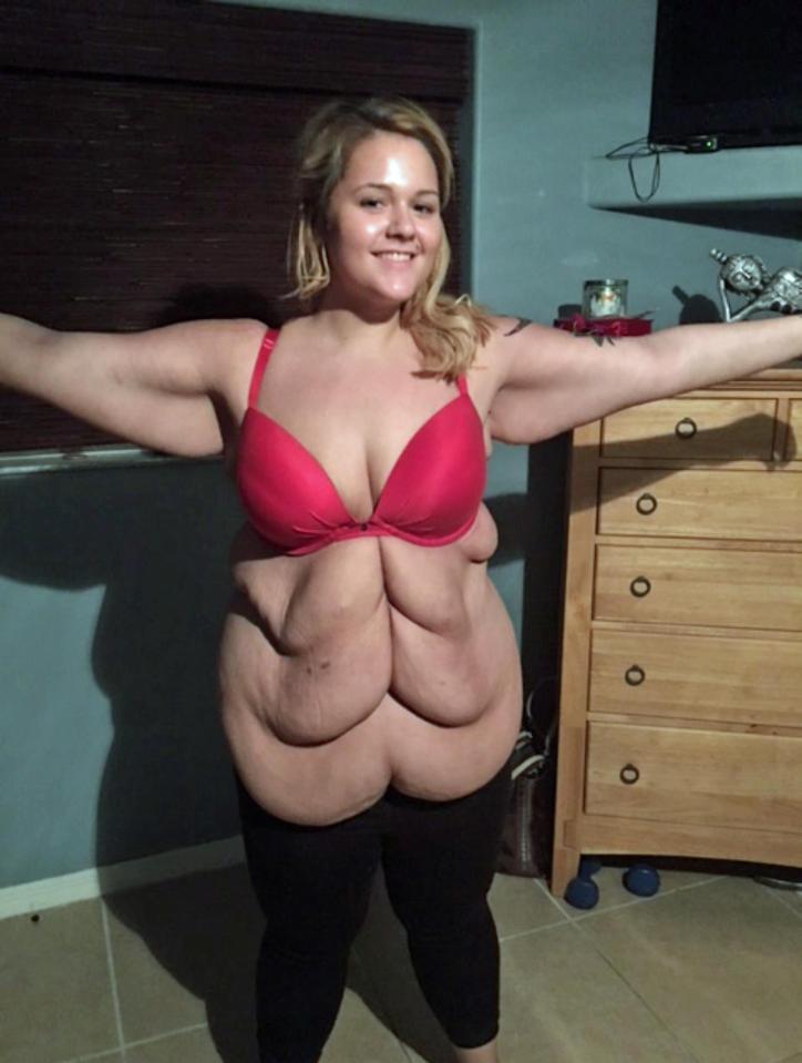  Kylie lost an impressive amount of weight but was left with a saggy 'six pack' of excess skin