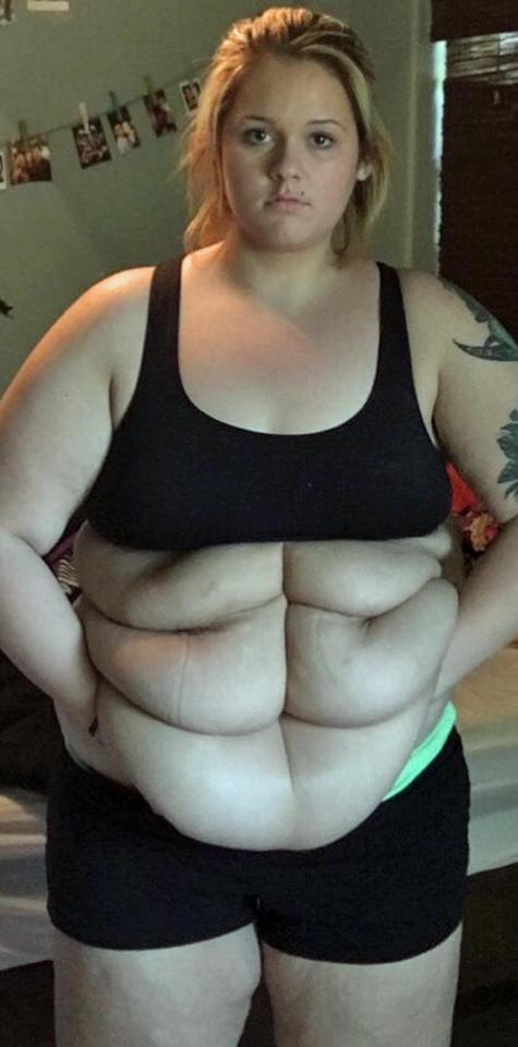  Kylie had what she called a 'six pack of rolls' before surgery to remove over two stone of excess skin from her body