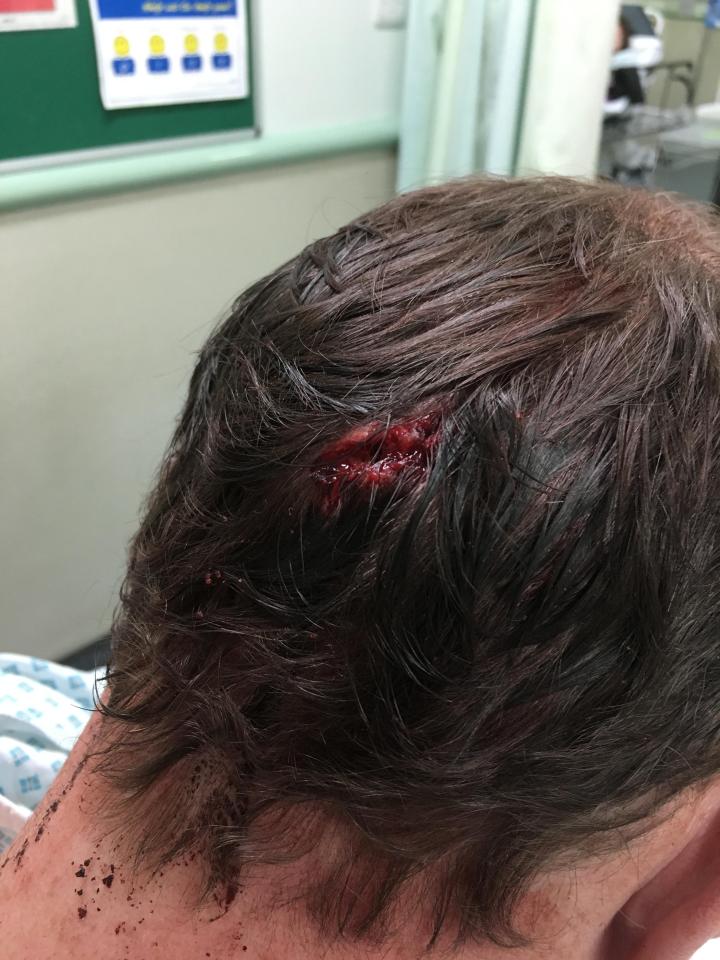  Simon was left with head injuries including a deep gash where he was struck with a weapon