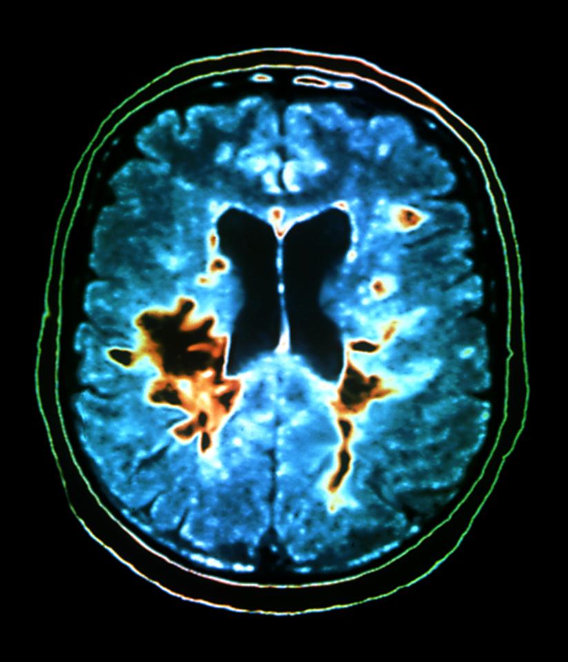  There are three main types of MS people can develop