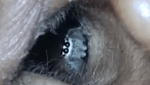  The spider filmed crawling out of a woman's ear in India