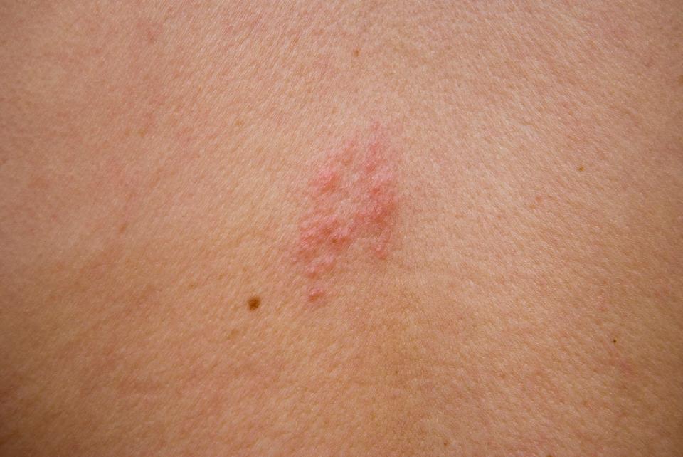  One in four people are likely to suffer shingles, which has been found to increase a person's risk of heart attack or stroke