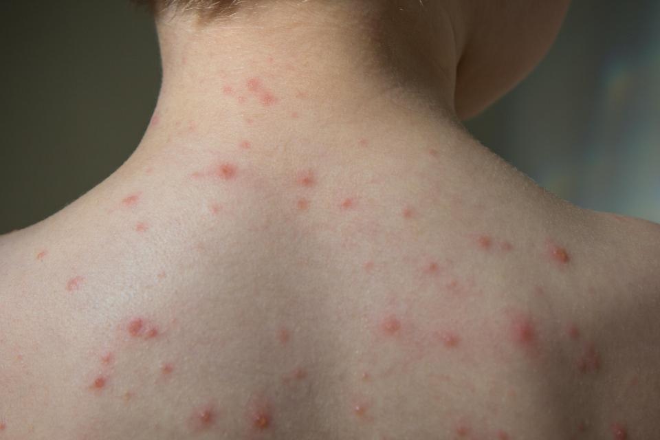  If you suffered chickenpox as a child, the varicella-zoster virus remains inactive in the body, and can cause shingles later in life