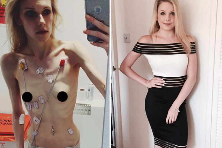  Jodie-Leigh’s weight plummeted to just 5st 5lbs at her sickest, but now she looks completely unrecognisable