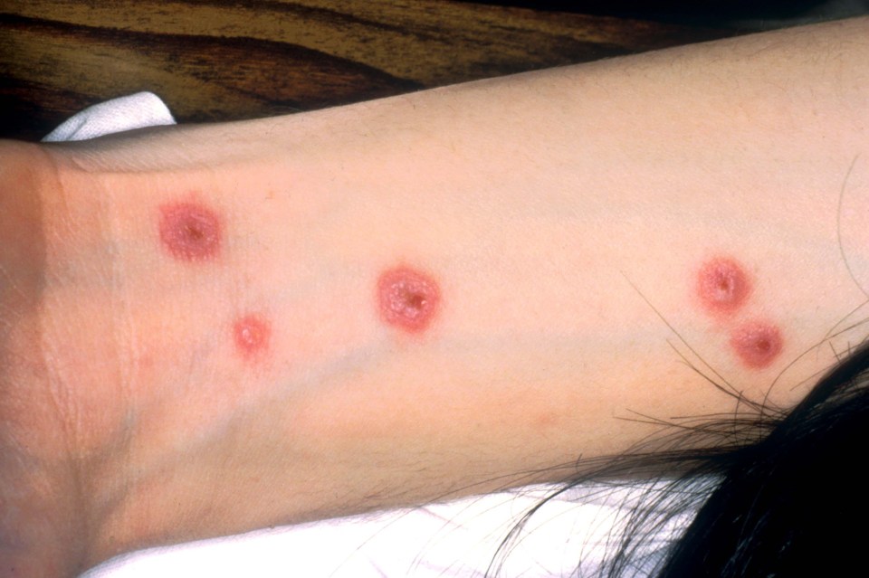 Stevens-Johnson syndrome can be spotted with an unusual rash that looks like targets (pictured)