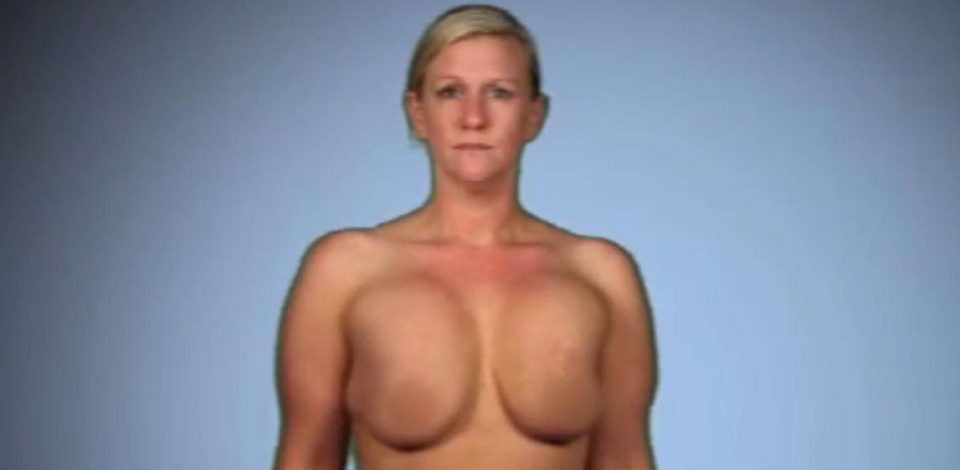  Sarah said a botched boob job left her with implants that sat high on her chest and caused her shooting pains in her left arm