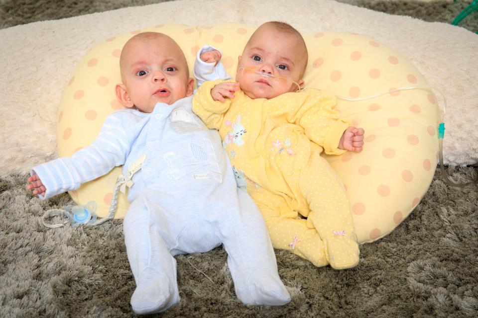  Twins Albert (left) and Molly (right) have beaten the odds to stay alive despite being born at 23 weeks