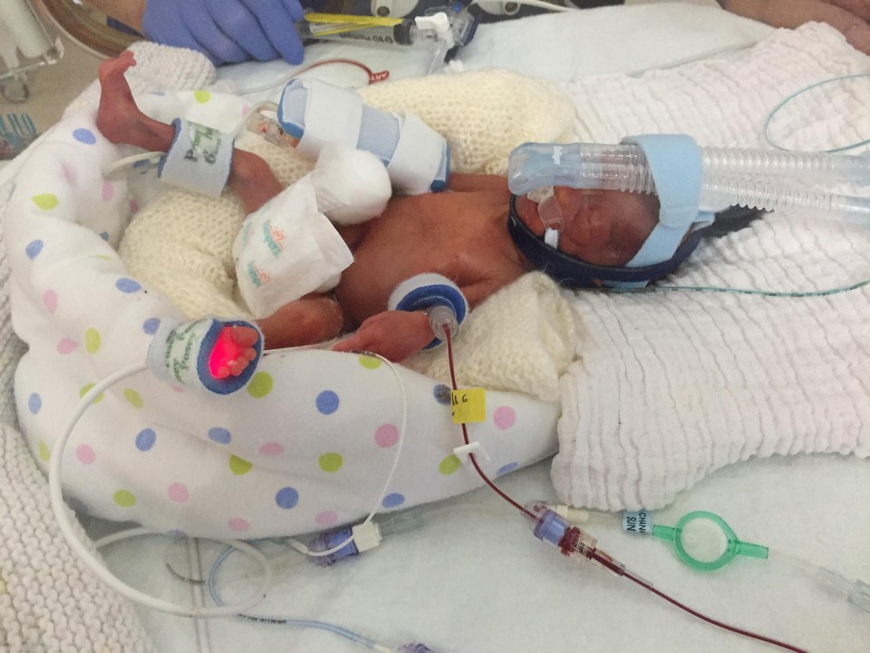 Albert was born five days after Dolly and placed on a ventilator 