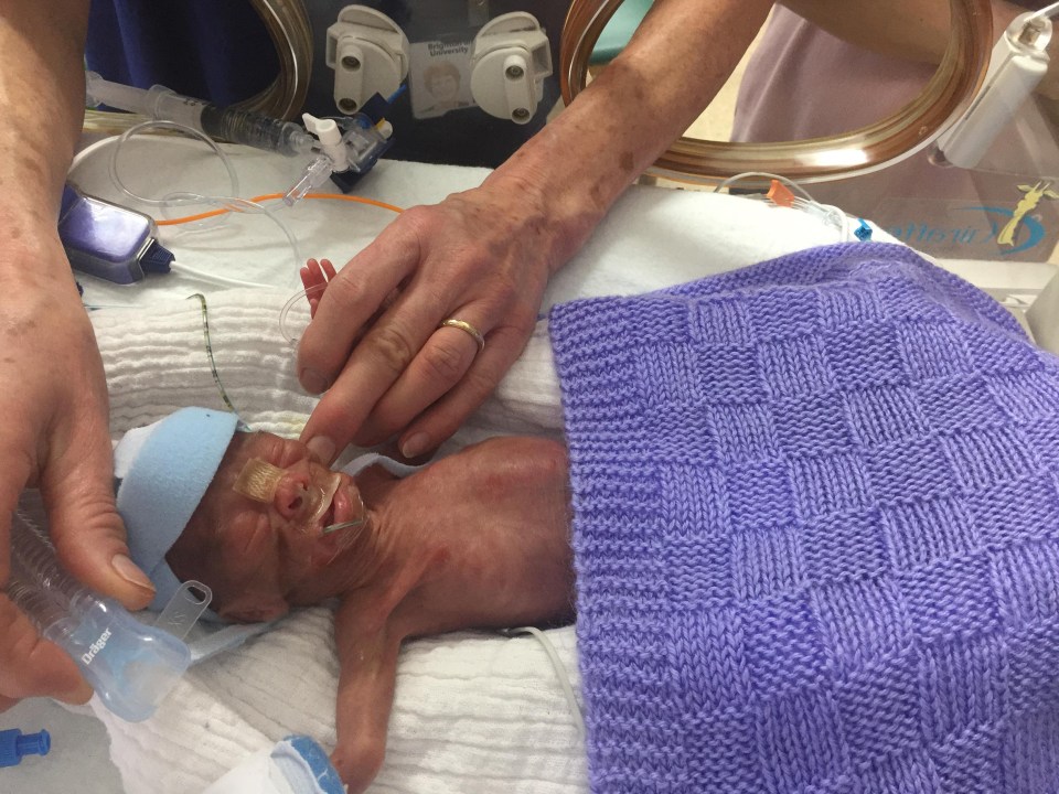 Albert at just four days old on a ventilator at Brighton Hospital 