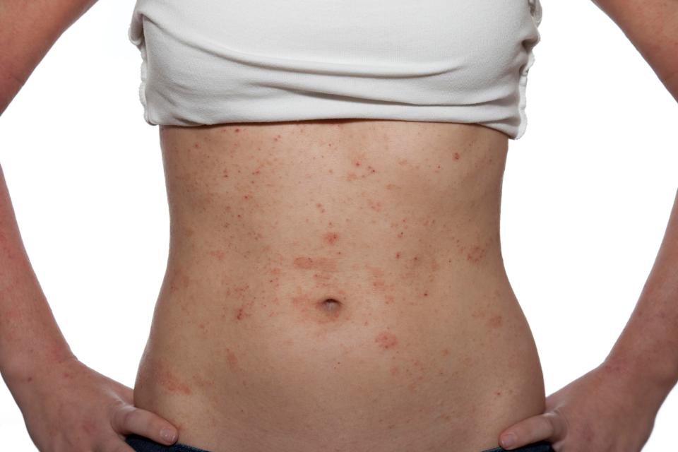  Eczema is a common skin condition that causes red, dry patches to appear on the skin