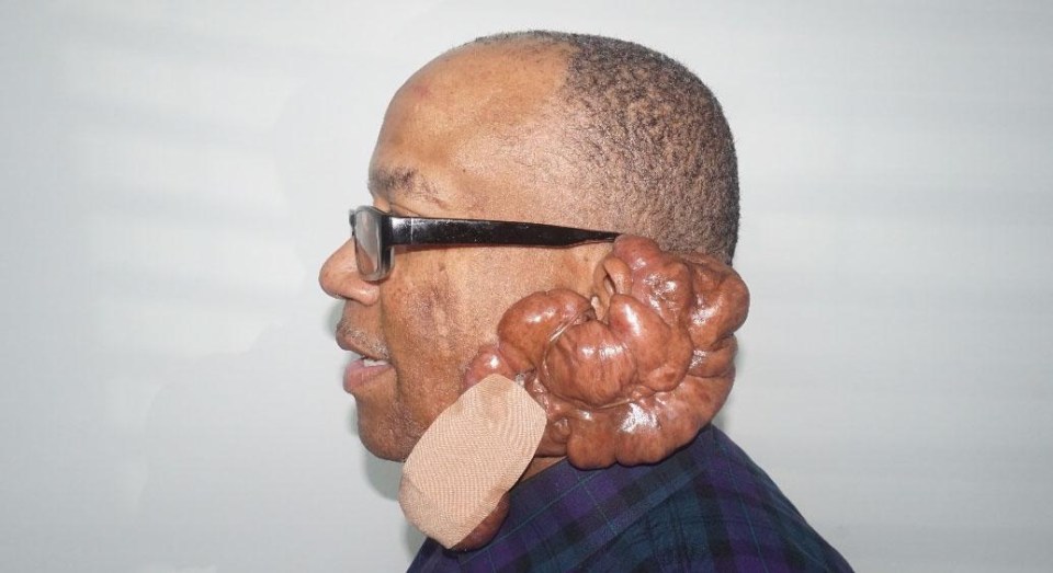 The keloid scars on Keith's neck grew so large they weighed more than 40lbs