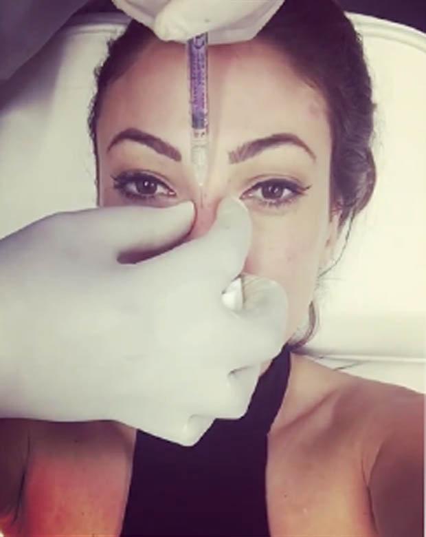  She recently shared a live video of her getting a non-surgical nose procedure