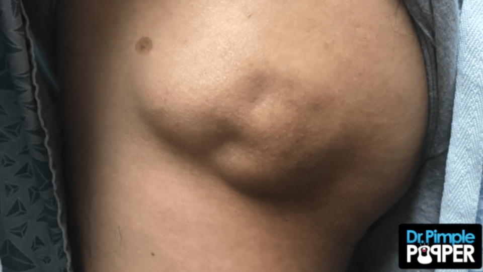  Recently Dr Pimple Popper, aka Dr Sandra Lee, tackled a 50-year-old cyst that resembled a baby's face