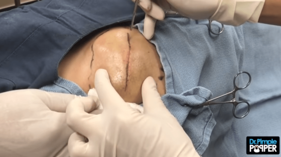  She started by making a neat incision along the length of the pus-filled area