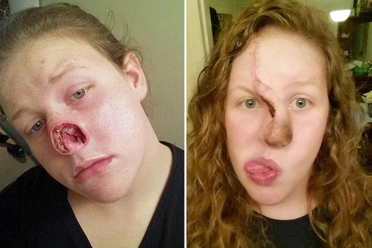  The cancer ravaged her face and caused her to lose her nasal cavity, palette and eight teeth