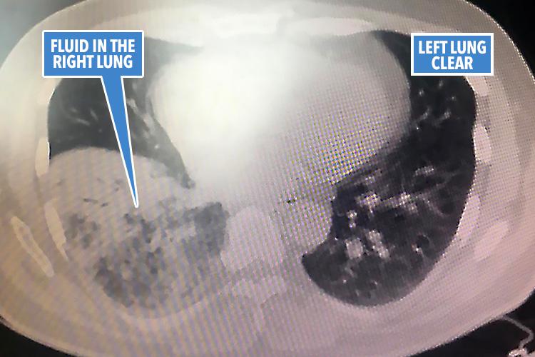 Clarkson's alarming chest scan highlights fluid in his right lung