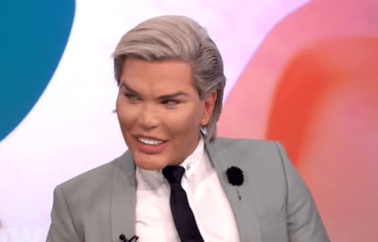  The Human Ken Doll is also having a hair transplant