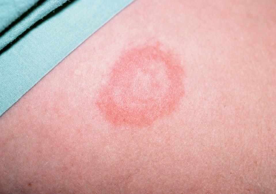 Lyme disease is commonly identified by a 'bull's eye' rash