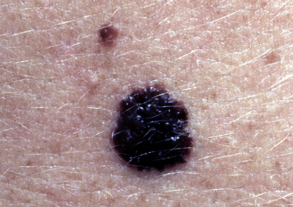 Warning signs of a melanoma include a change in colour and size