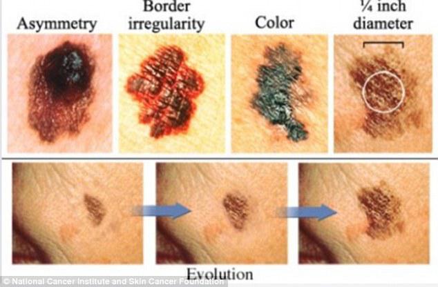 Checking your mole against the ABCDE checklist can help you tell if it is cancerous