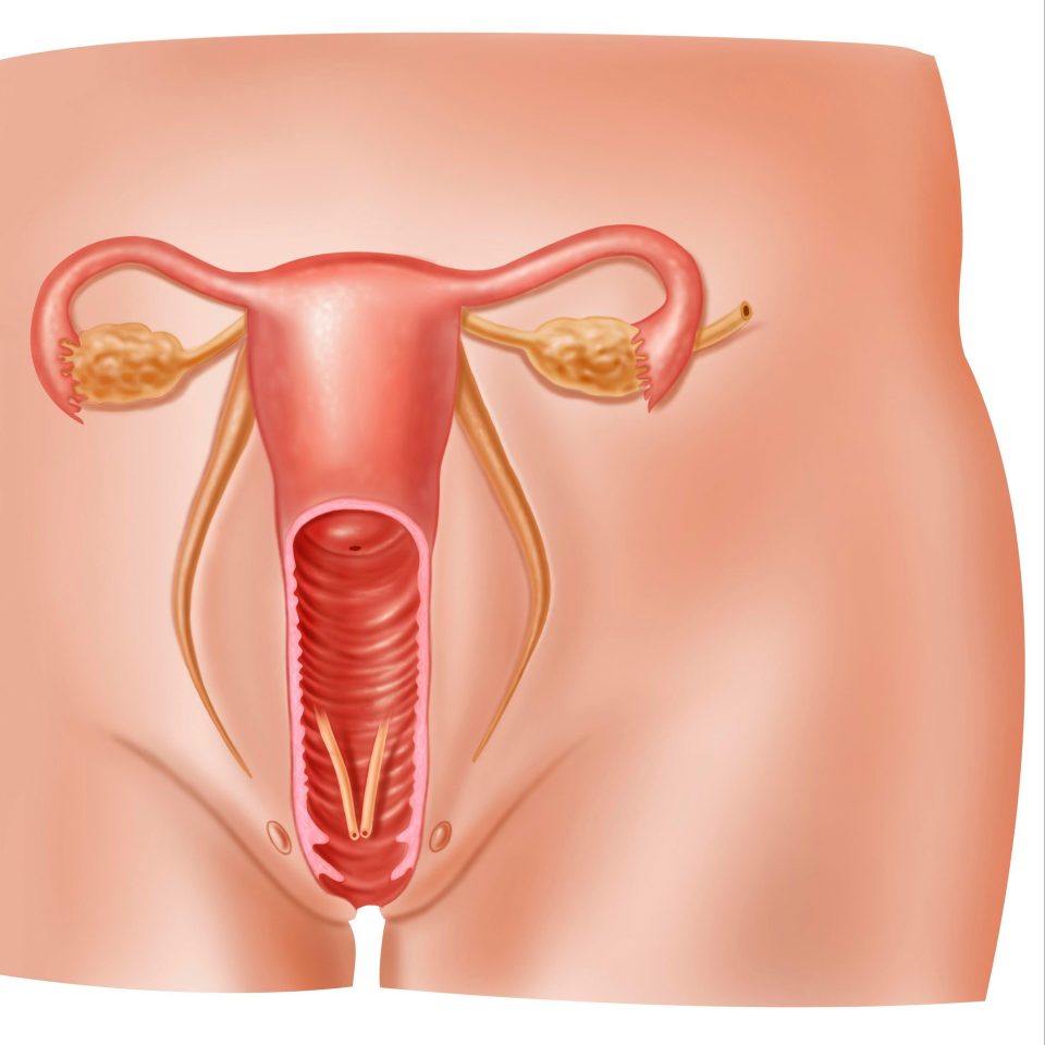  Vaginal atrophy caused the walls of the vagina to become thin and dry