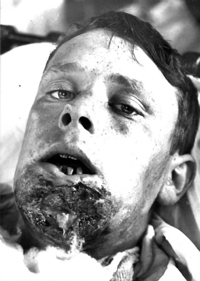  Soldier Harold Mann had part of his face blown off during the fighting