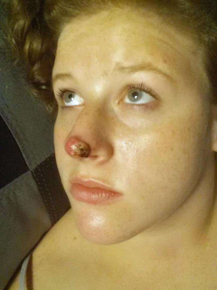  Marisha first noticed a pimple-like spot on her nose double in size three years ago